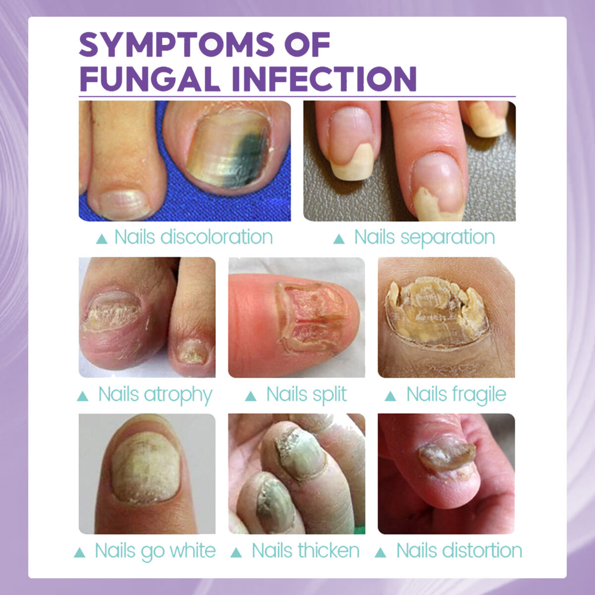 ⁦• NAIL FANGUS SPRAY⁩ - الصورة ⁦11⁩